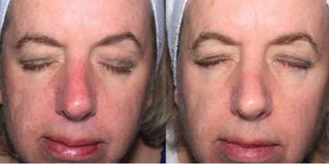 Excel V laser vein removal face