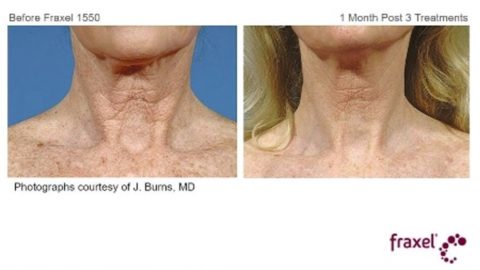 Fraxel neck hyperpigmentations before and after