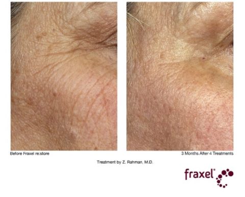 Fraxel crows feet hyperpigmentations before and after