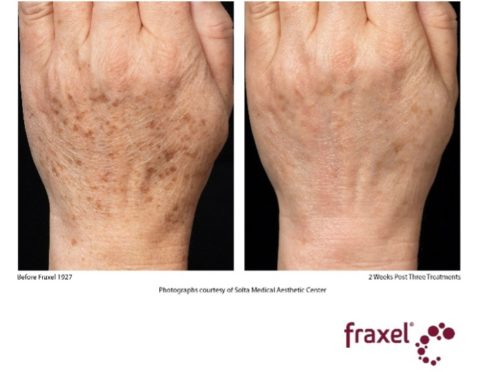 Fraxel hands before and after