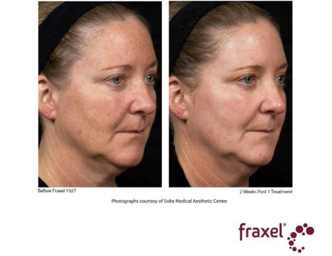 Fraxel face hyperpigmentations before and after